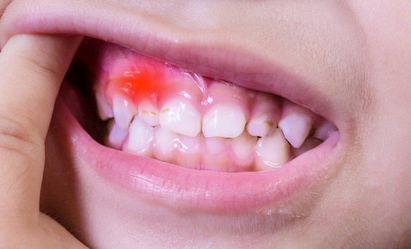 Bé bị nhiệt miệng chảy máu chân răng là tình trạng khá phổ biến