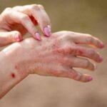Bệnh da liễu như ghẻ, mề đay khiến da bị ngứa về đêm