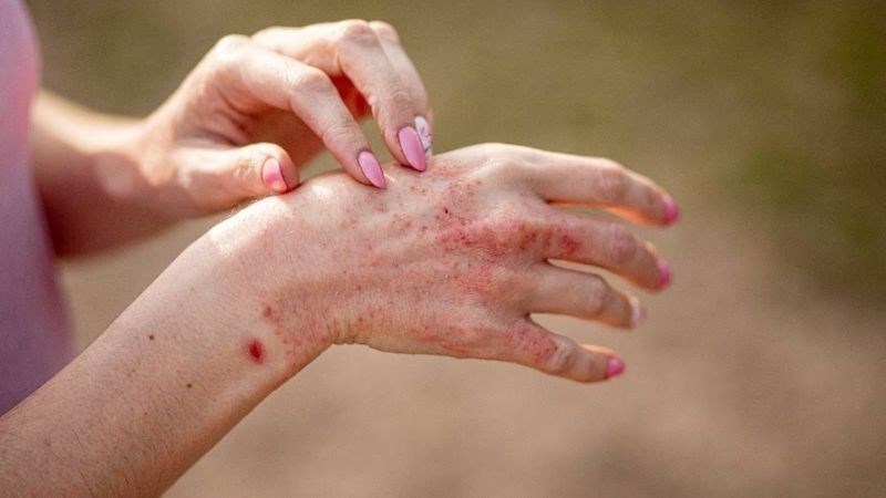 Bệnh da liễu như ghẻ, mề đay khiến da bị ngứa về đêm