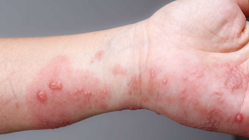Bệnh ghẻ gây ngứa ngoài da