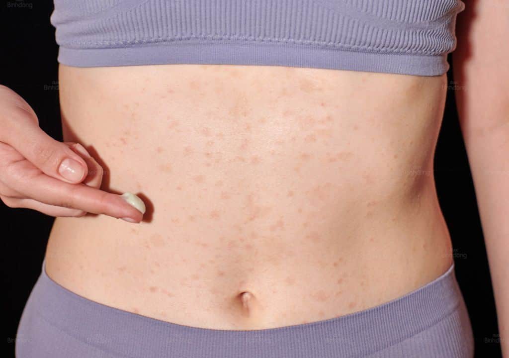 Bị ngứa vùng bụng có thể là dấu hiệu của bệnh chàm