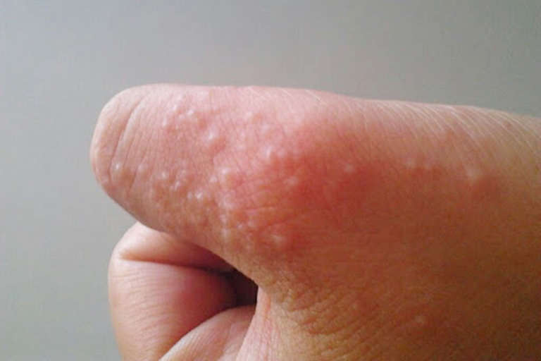 Bị tổ đỉa khi mang thai là hiện tượng không hiếm gặp