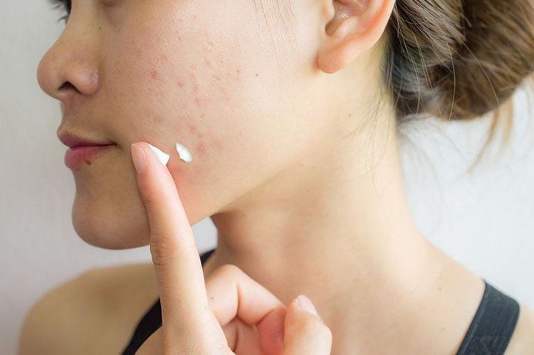 Có rất nhiều loại sản phẩm giúp chăm sóc da mụn hiệu quả
