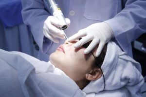 Đốt tàn nhang bằng tia laser nào phụ thuộc vào loại tàn nhang, loại da và vấn đề mà da bạn đang gặp phải