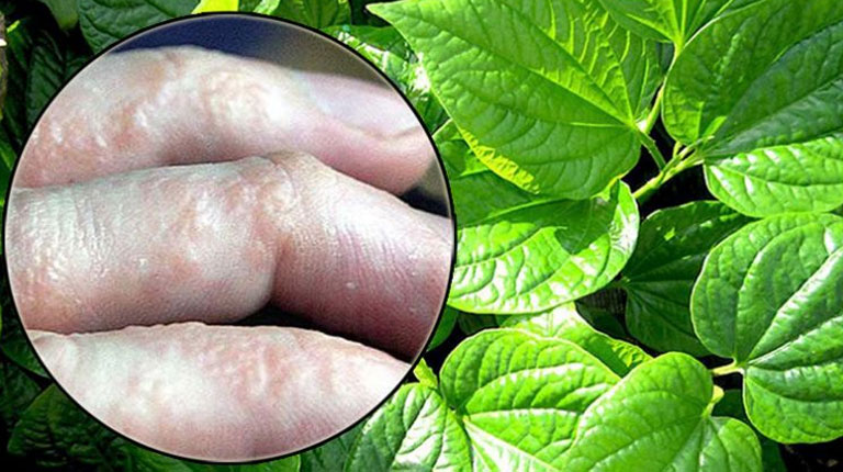 Dùng lá lốt cho trường hợp bị tổ đỉa khi mang thai