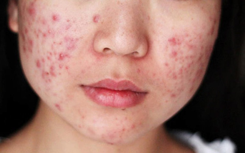 Mọc mụn trứng cá cũng khiến da dễ bị ngứa