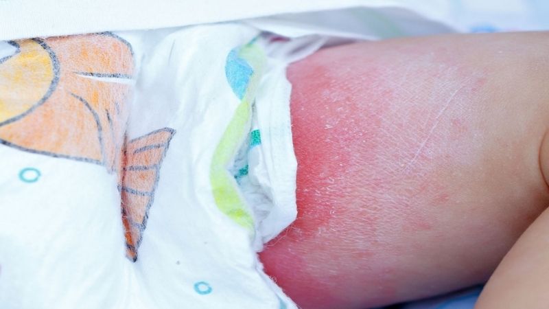Một trong những nguyên nhân dẫn đến phát ban ở trẻ nhỏ là hăm tã