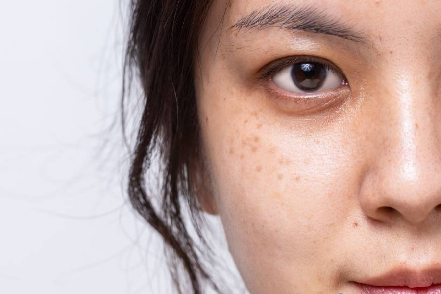 Một trong những nỗi ám ảnh lớn nhất của phái đẹp đó là tàn nhang xuất hiện trên mặt