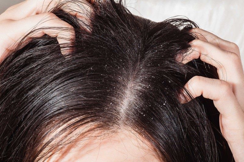 Muối có công dụng kháng khuẩn đồng thời còn có thể tẩy da chết cho da đầu