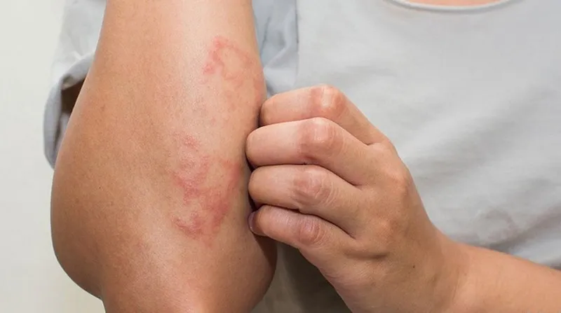 Ngứa da là tình trạng da liễu khá phổ biến