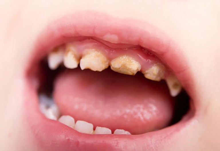 Nguyên nhân dẫn đến bé bị viêm nha chu