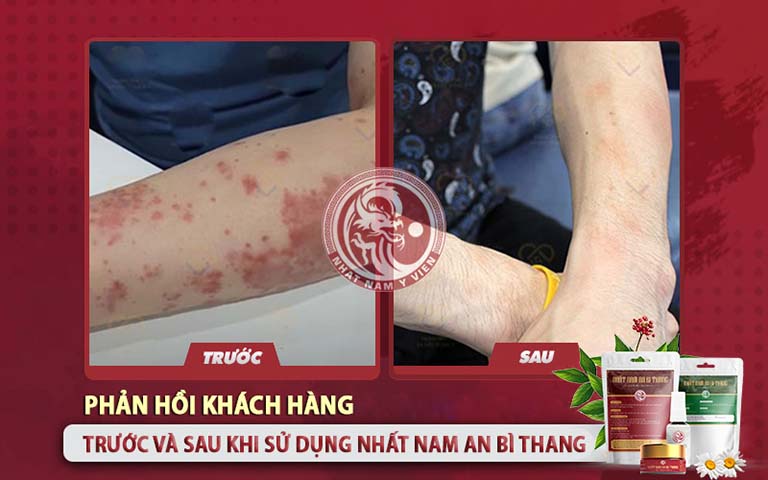 Sự thay đổi của vùng da vảy nến sau khi dùng Nhất Nam An Bì Thang