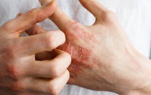 Viêm da tiếp xúc gây ngứa ngáy khá khó chịu